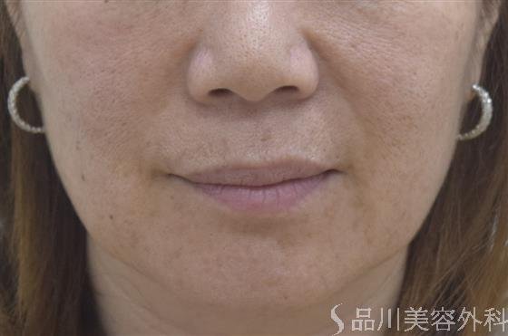 症例NO.46121のBEFORE写真