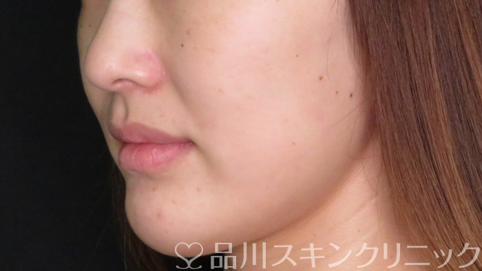 症例NO.71011のBEFORE写真