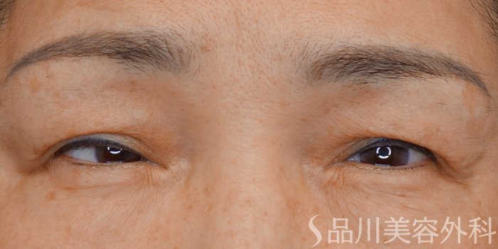 症例NO.72861のBEFORE写真