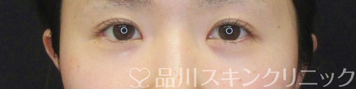 症例NO.65163のAFTER写真