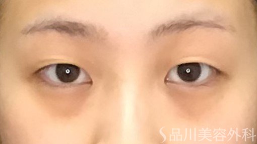 症例NO.71360のBEFORE写真
