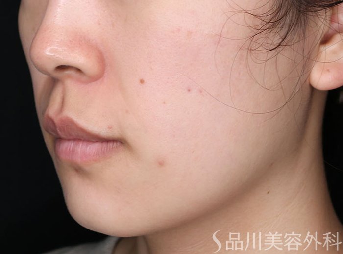 症例NO.64839のBEFORE写真
