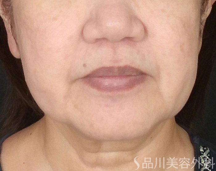 症例NO.65497のBEFORE写真