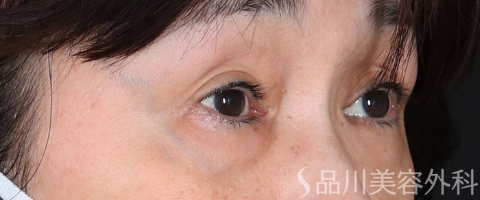 症例NO.73054のBEFORE写真