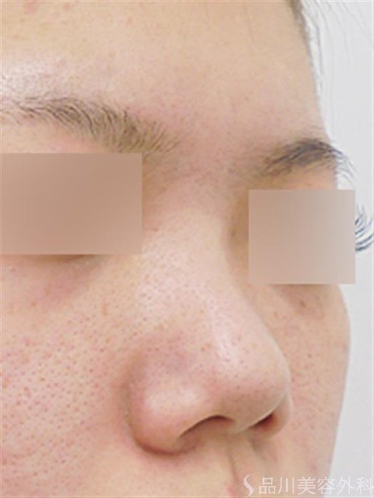 症例NO.40843のBEFORE写真