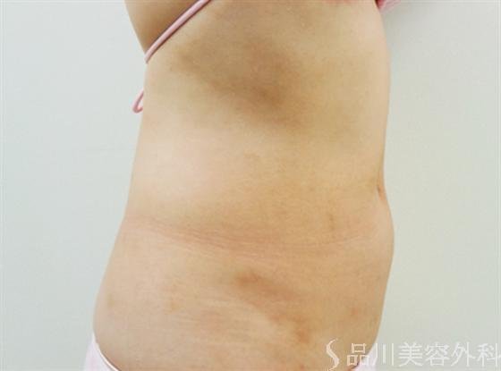 症例NO.17333のBEFORE写真