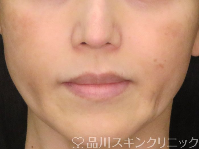 症例NO.70721のBEFORE写真