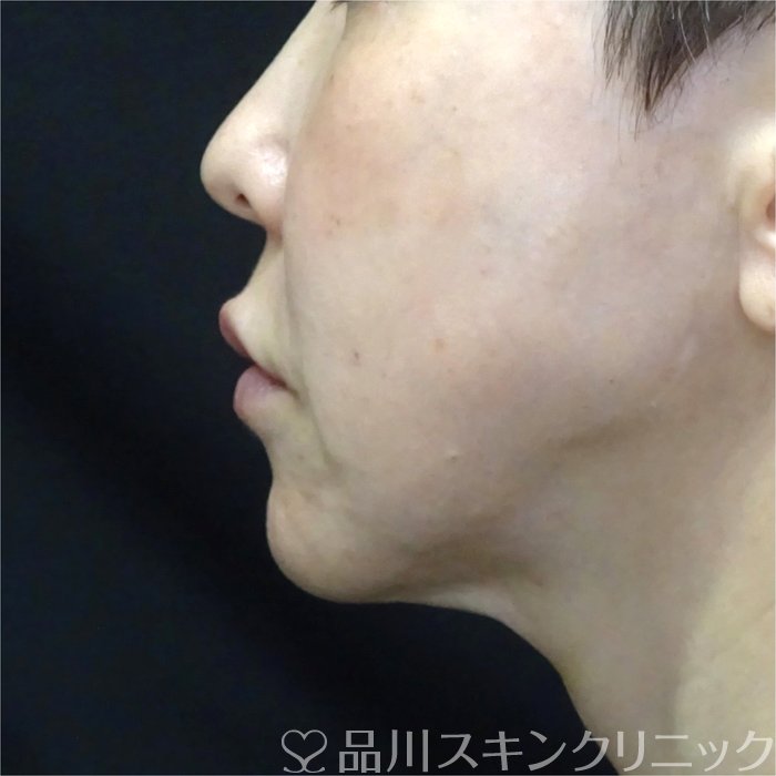 症例NO.70423のAFTER写真