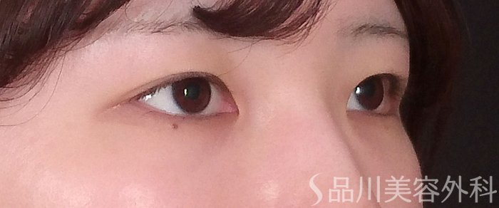 症例NO.70104のBEFORE写真