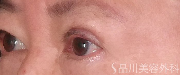 症例NO.70277のAFTER写真
