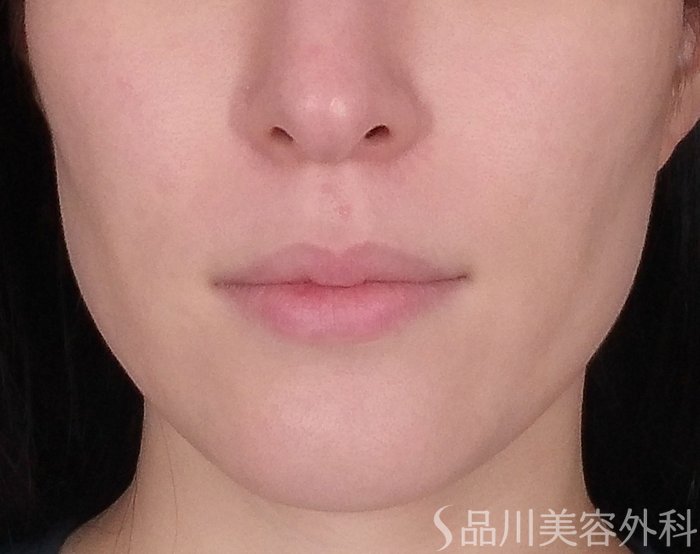症例NO.70944のBEFORE写真