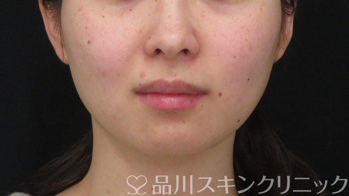 症例NO.72149のBEFORE写真