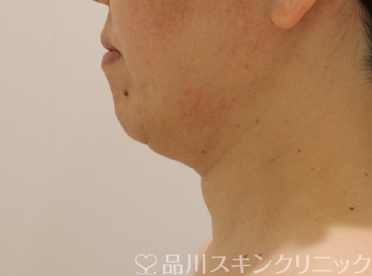 症例NO.73295のBEFORE写真