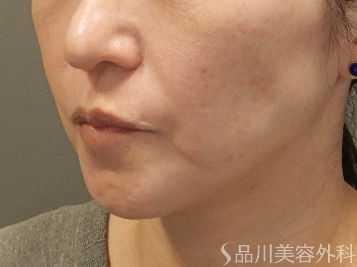 症例NO.70357のBEFORE写真
