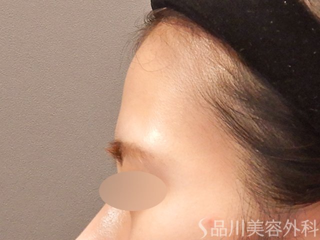 症例NO.72529のBEFORE写真