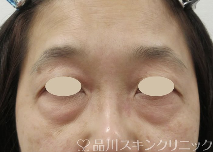 症例NO.69422のBEFORE写真