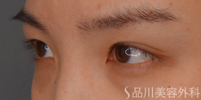 症例NO.75357のBEFORE写真