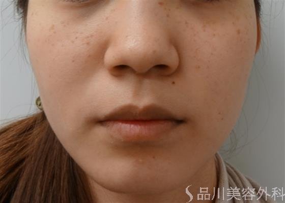 症例NO.25954のBEFORE写真