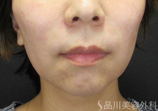 症例NO.69223のAFTER写真