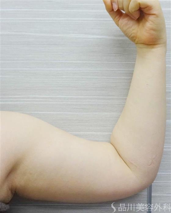 症例NO.37176のBEFORE写真