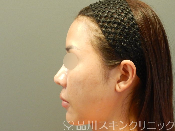 症例NO.65033のBEFORE写真
