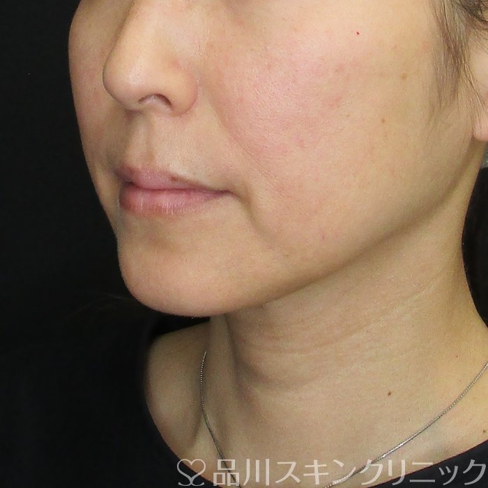 症例NO.74084のBEFORE写真