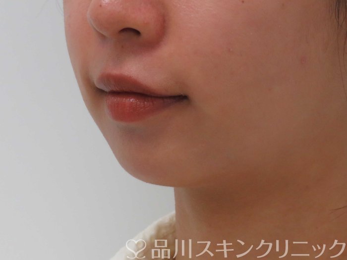 症例NO.71468のBEFORE写真