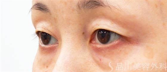 症例NO.53835のBEFORE写真