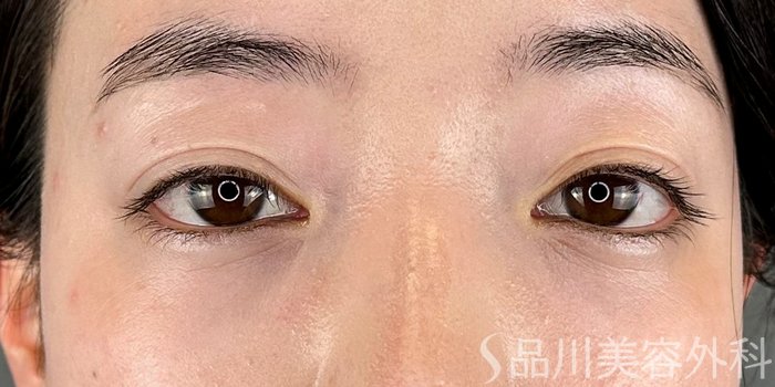 症例NO.72838のAFTER写真