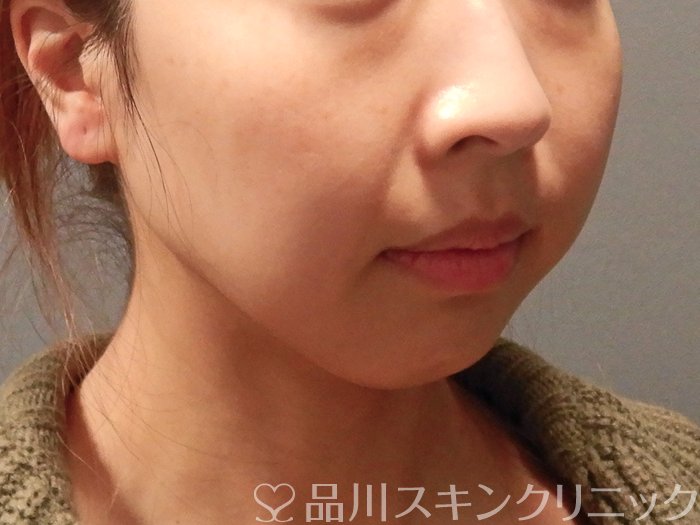 症例NO.63155のBEFORE写真