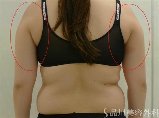 症例NO.43232のBEFORE写真