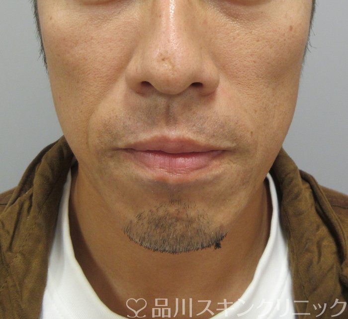 症例NO.74732のBEFORE写真