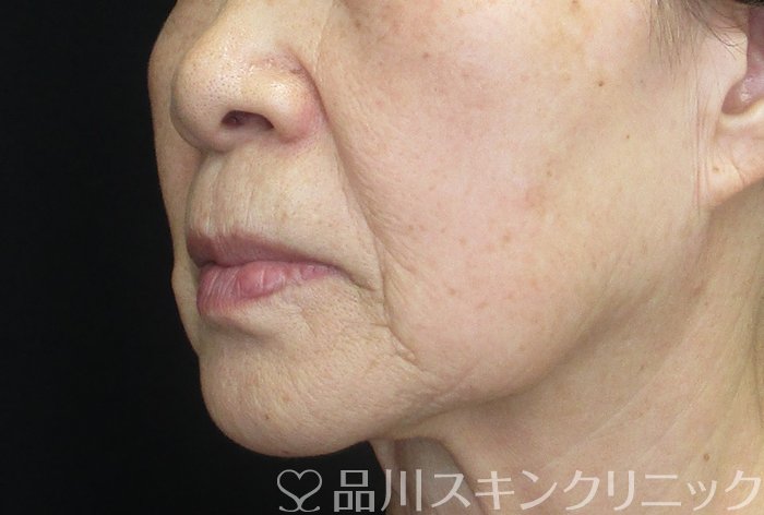 症例NO.73005のBEFORE写真