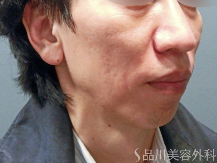 症例NO.63093のBEFORE写真