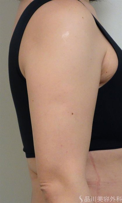 症例NO.41323のBEFORE写真