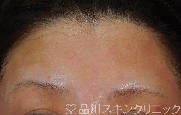 症例NO.66590のAFTER写真