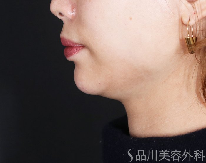症例NO.72810のAFTER写真
