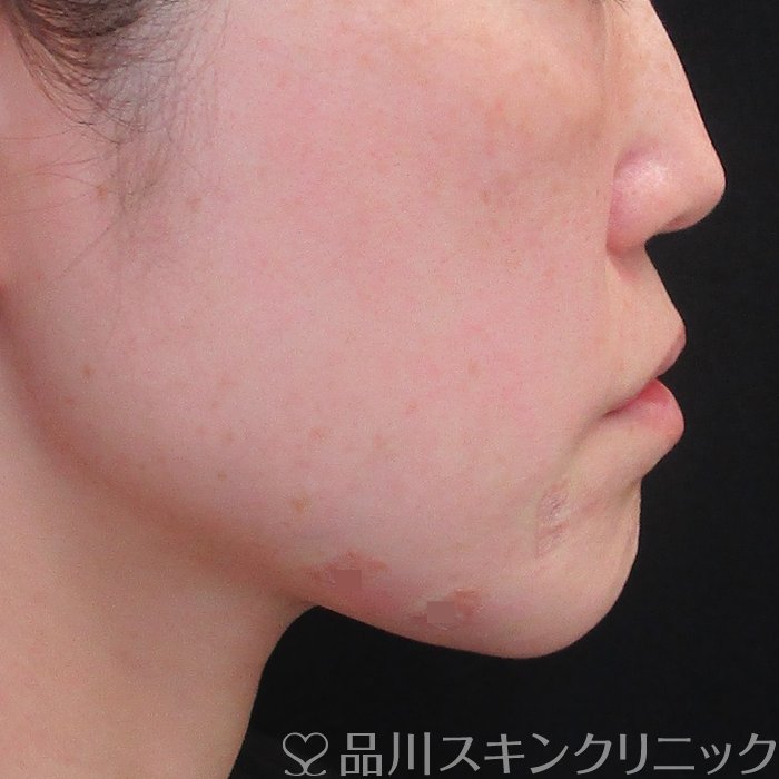 症例NO.73375のAFTER写真