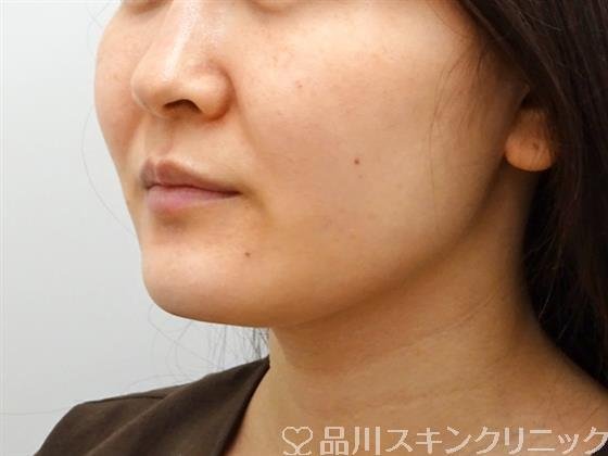 症例NO.52529のBEFORE写真