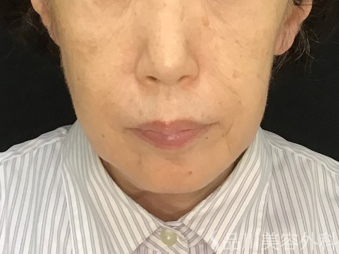 症例NO.71631のBEFORE写真