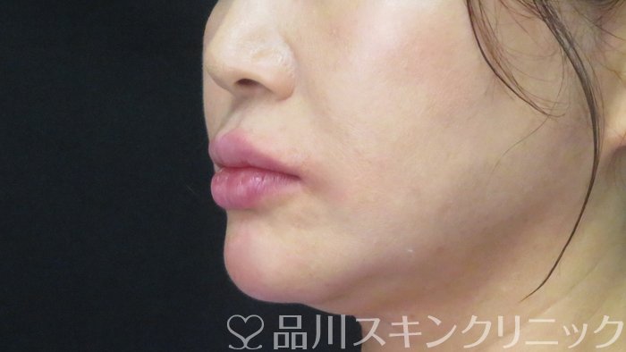 症例NO.72084のAFTER写真