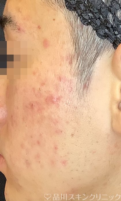 症例NO.69608のBEFORE写真