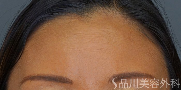 症例NO.71584のBEFORE写真