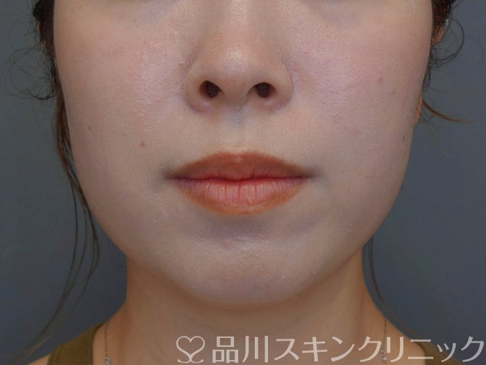 症例NO.74668のBEFORE写真