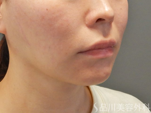 症例NO.73780のAFTER写真