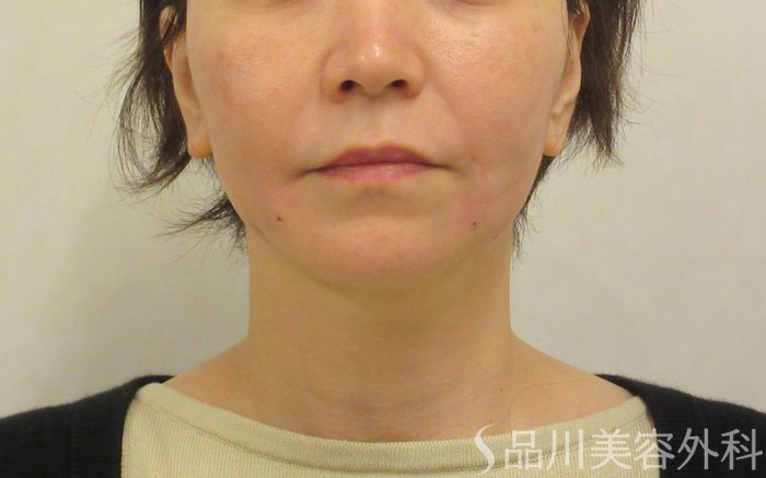 症例NO.72763のAFTER写真