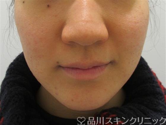 症例NO.26918のAFTER写真