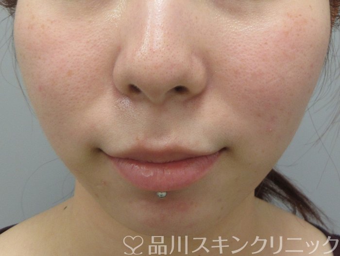 症例NO.70218のBEFORE写真