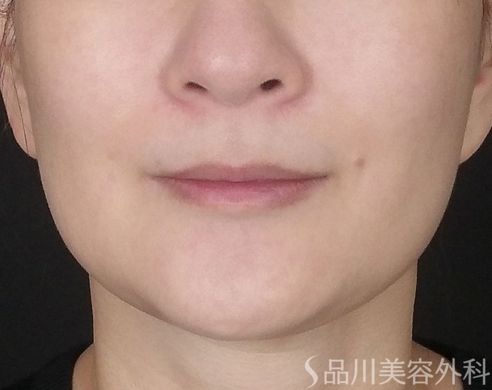 症例NO.67949のBEFORE写真