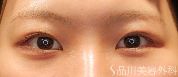 症例NO.71496のAFTER写真